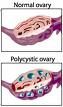 Ultrasound of PCOS