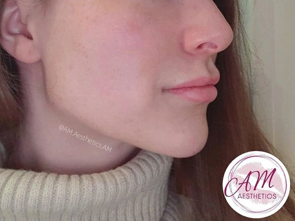 Jawline contouring Jawline fillers Facial Fillers Facial Contouring, Mill Hill London, Canary Wharf 