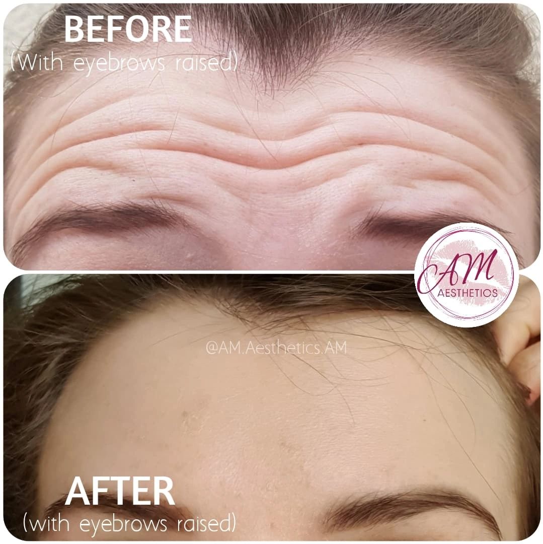 botox antiwrinkle anti-wrinkle face aesthetics forehead lines crows feet frown lines London wrinkles