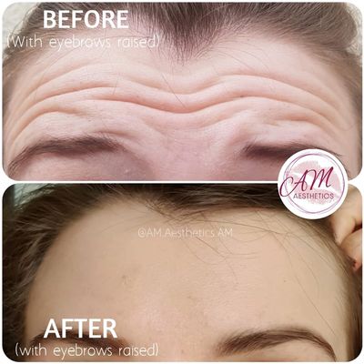 anti-wrinkle, botox, wrinkles, london, Mill Hill, North West London, Canary Wharf. East London
