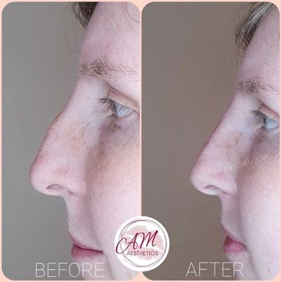 Nose fillers, London fillers, non-surgical nose job facial fillers Canary Wharf Mill Hill