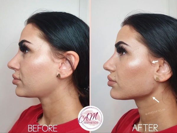 Jawline Fillers, Cheek Filler, Facial Contouring, Facial Fillers, Mill Hill London, canary wharf 