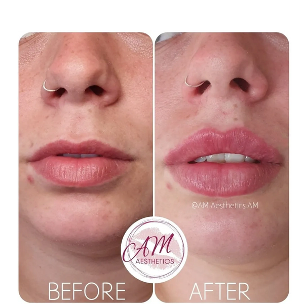 Lip Fillers, Russian Lip Filler, Lip facial fillers, Facial treatments, Canary Wharf London, Lips