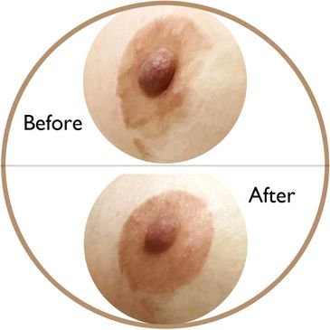 SUMA Ink - 3D Nipple Areola Tattoo, Breast Reconstruction Tattoo SUMA Ink - 3D Nipple Areola Tattoo, Breast Reconstruction Tattoo