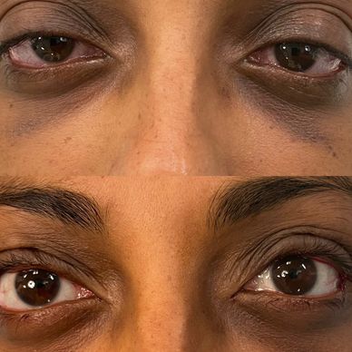 Posterior Ptosis- “Scar Free” method is suitable for patients who wish to avoid skin (anterior) inci