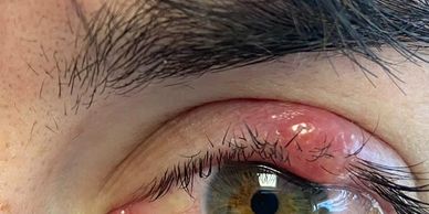 Left upper lid Chalazion 