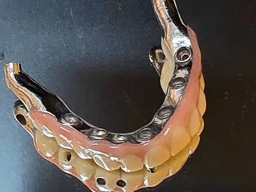 A Titanium bar supporting Zirconia teeth waiting to be fitted to restore smile and function at SIG.