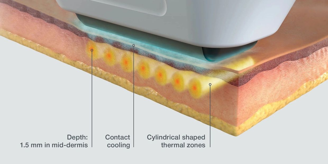 Sofwave how it works 