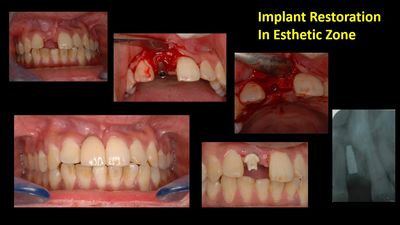 Dental implant done by an implantologist at align orthodontics. implant in the aesthetic zone with z