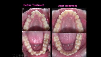 Orthodontic treatment with premolar extractions for stable post orthodontic treatment results