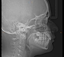 x-rays are needed to see what orthodontic treatment be given. Orthodontic treatment with Xn or nonXn