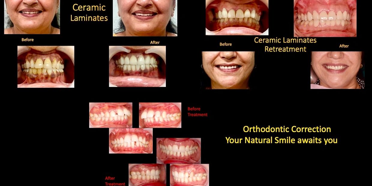 Before and after images of dental treatments showing improved smiles with ceramic laminates and orthodontic correction.