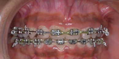 Orthodontic treatment with metal braces. Orthodontic treatment with ceramic braces