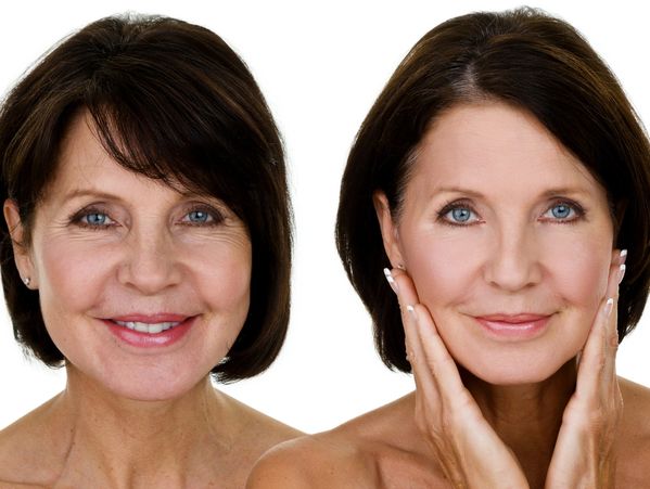 PRP vampire facial for skin tightening, anti aging, fine lines and wrinkles