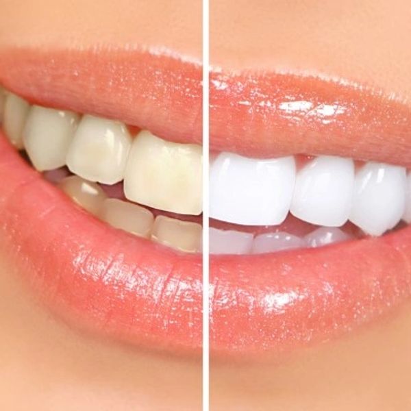 Teeth whitening West Palm Beach
Facials Wellington
Esthetician Royal Palm Beach