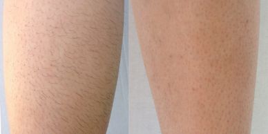 Laser hair removal