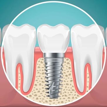 dental implants, all on 4, dental crown, Las Vegas dentist, southwest dentist, affordable dental imp