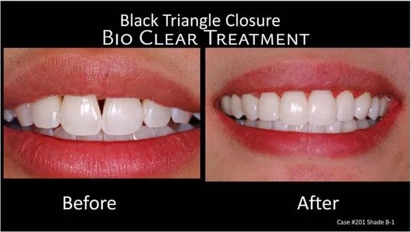 supreme dental, best dentist, dentist near me, bio clear, black triangle