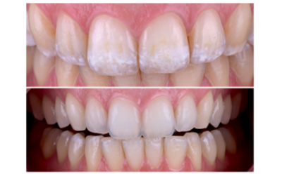 teeth, teeth whitening, cosmetic dentistry, white spot lesions, dentist near me, best dentist