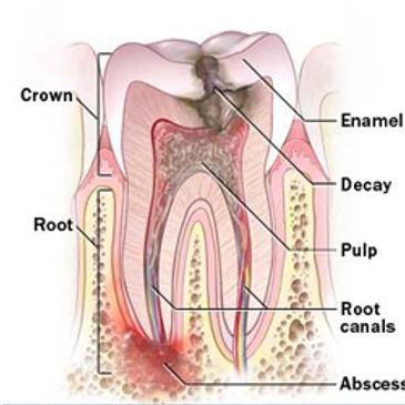 root canal, dentist, dentist in Las Vegas, Endodontics, molar root canal, dental infection