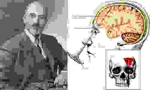 Lobotomy argumentative essay image