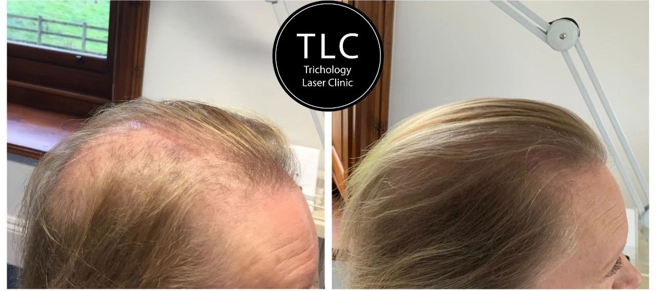 Fine hair after breast cancer treatment with chemotherapy radiotherapy.  Blasted with minoxidil oral