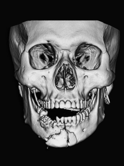 fracture x-ray from facial trauma facial trauma surgeon facial trauma surgery nwi northwest indiana r