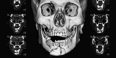 jaw fracture x-ray for facial trauma for oral surgery