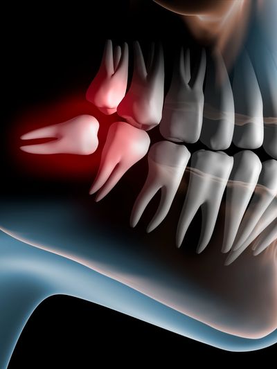 wisdom teeth removal wisdom tooth extraction impacted wisdom tooth pain surgery gentle pain free