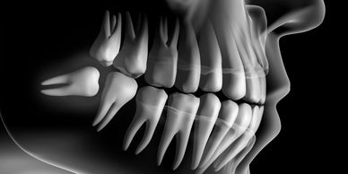 wisdom tooth removal pain impacted wisdom teeth extraction for wisdom teeth