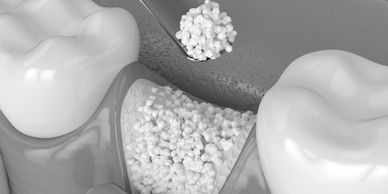 bone grafting material used for bone grafts and sinus lifts