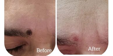 MOLE REMOVAL HEALTH AND BEAUTY BY FRANCESCA SACCO