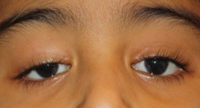 Droopy eyelid ptosis