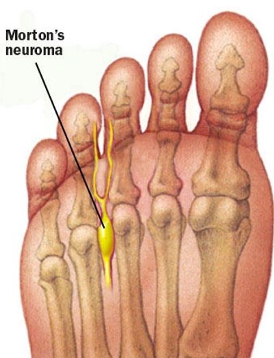 Неврома мортона на рентгеновском снимке фото