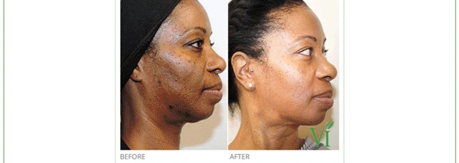 Chemical Peels Faceline Aesthetics