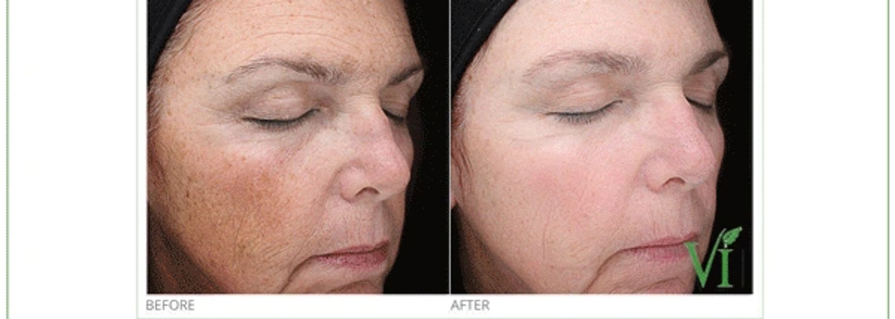 Chemical Peels Faceline Aesthetics