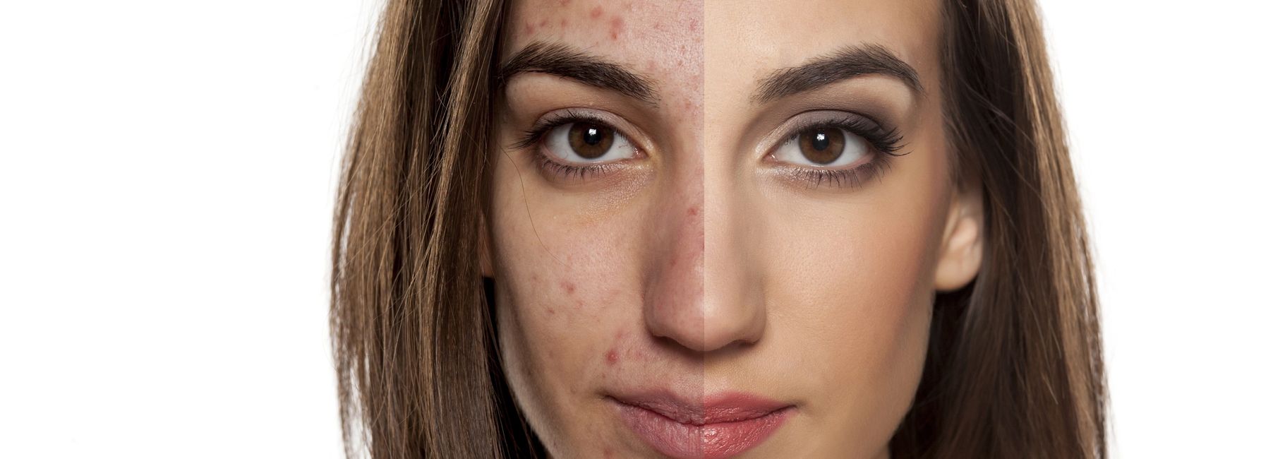 Chemical Peels Faceline Aesthetics