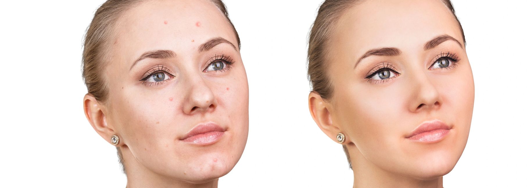 Acne Acne Scar Therapy Faceline Aesthetics