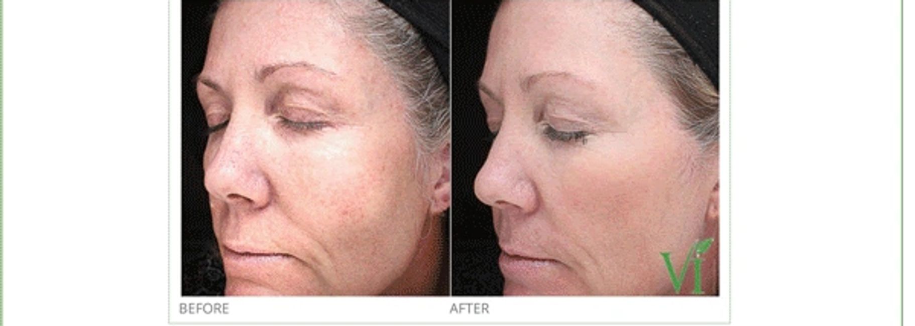 Chemical Peels Faceline Aesthetics