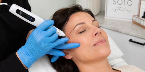 Non surgical lift face lift with Plaxel Plasma Pen at Solo Esthetics And Skin Spa, Sterling VA