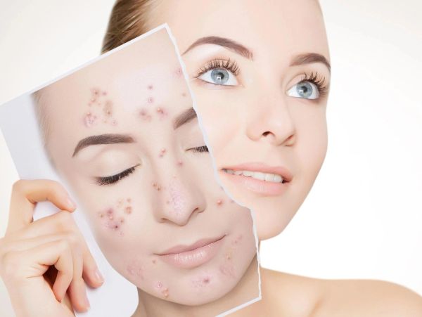Personalized Acne Treatment at Solo Esthetics And Skin Spa, Sterling VA