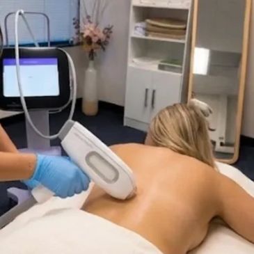 Laser Hair Removal Offer — Full Body (all areas) at Solo Esthetics And Skin Spa in Sterling, VA