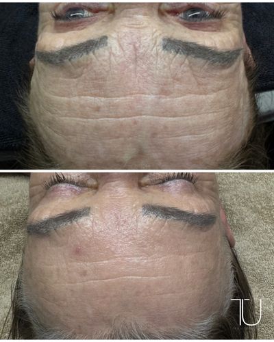 Before and after Botox treatment showing improvement in forehead wrinkles in Franklin, TN