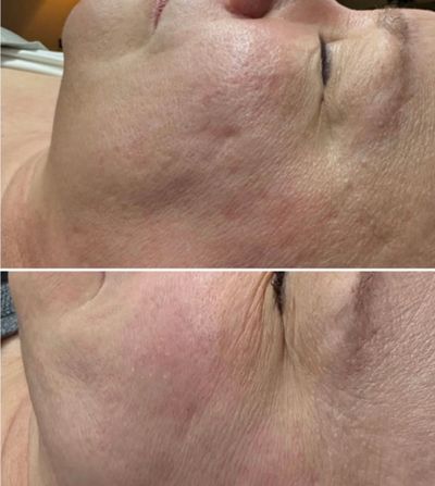 Green Sea Peel before and after improving skin texture Tru U Esthetix Franklin TN