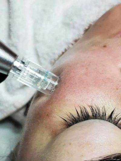 Close-up of a facial microneedling treatment being performed.