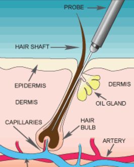 hair follicle removal