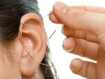 Ear acupuncture