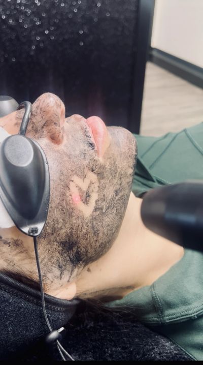 Man undergoing a laser tattoo removal treatment on his face.
