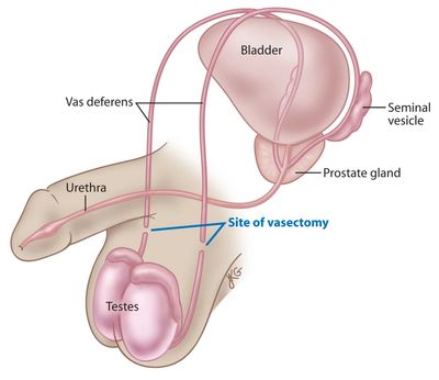 No Scalpel Vasectomy