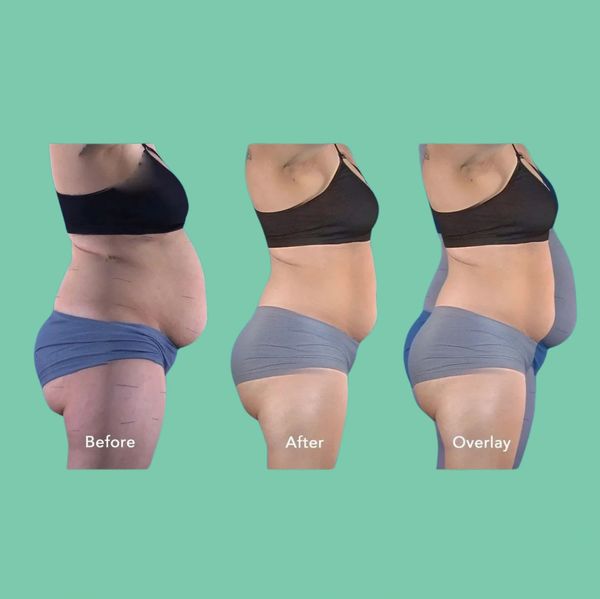 Dramatic midsection transformation using Bodhi Contouring body sculpting. Red light therapy Holistic wellness 